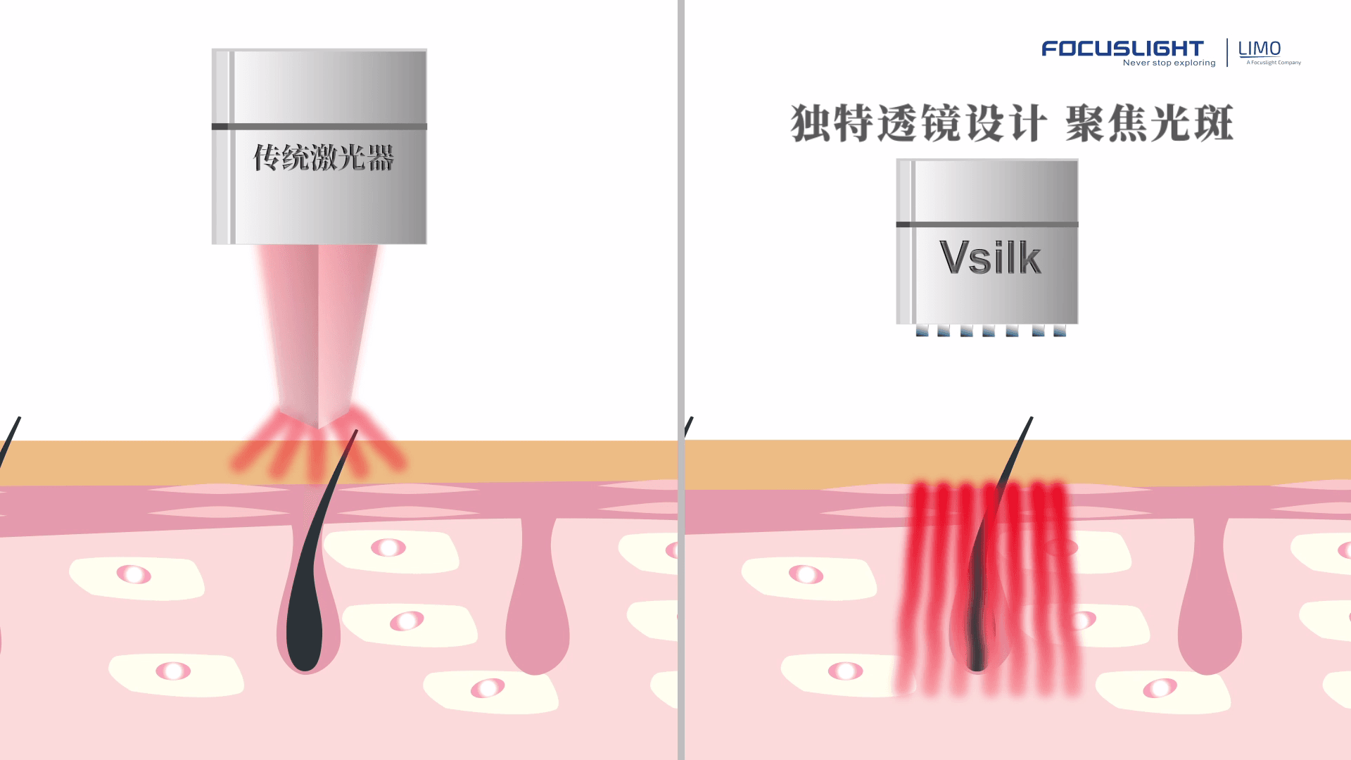 新品抢先看！Vsilk聚焦光斑激光脱毛模块